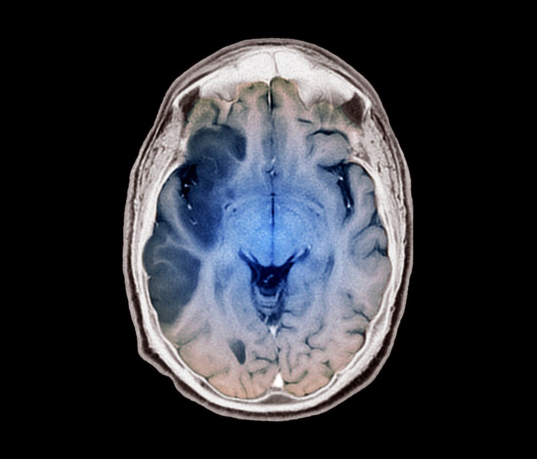Stroke, MRI brain scan