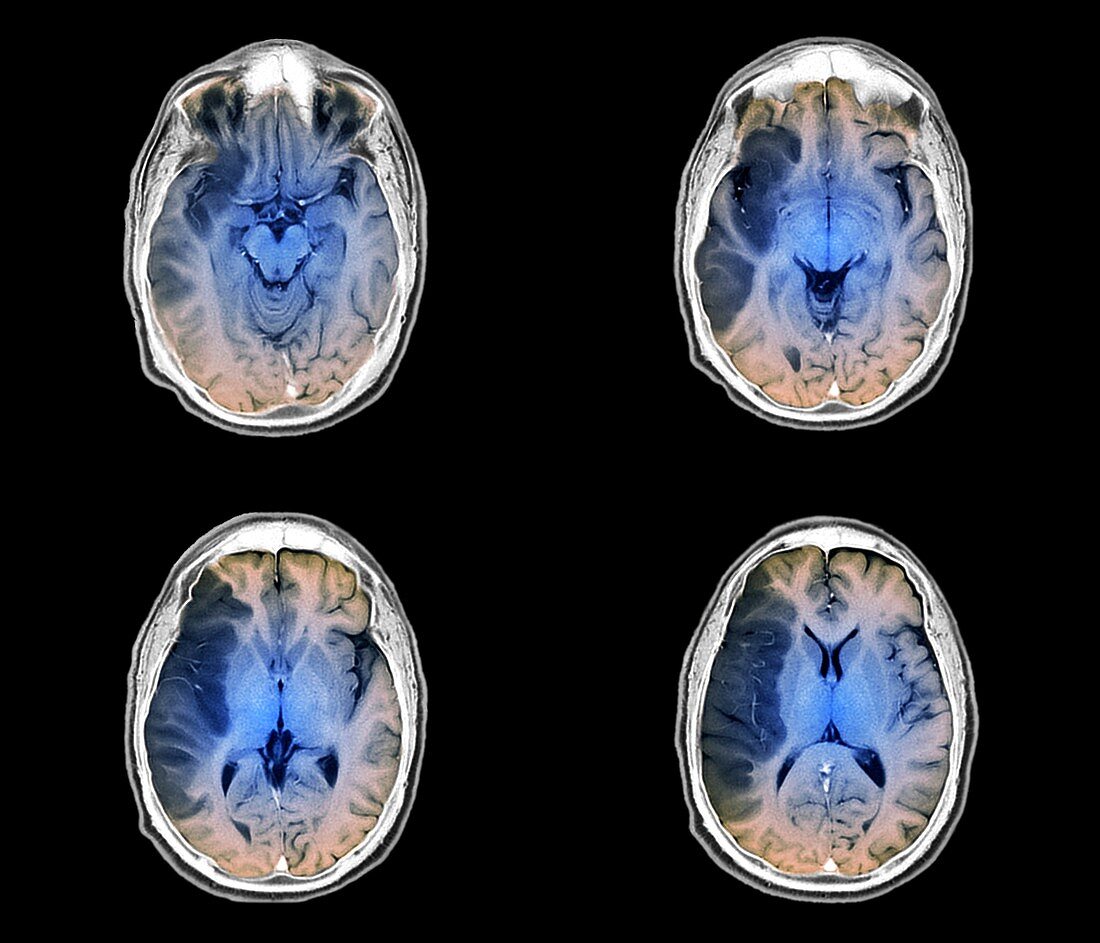 Stroke, MRI brain scans