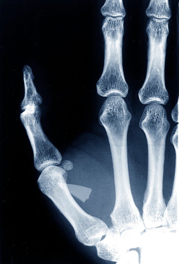 Glass shard in thumb, X-ray
