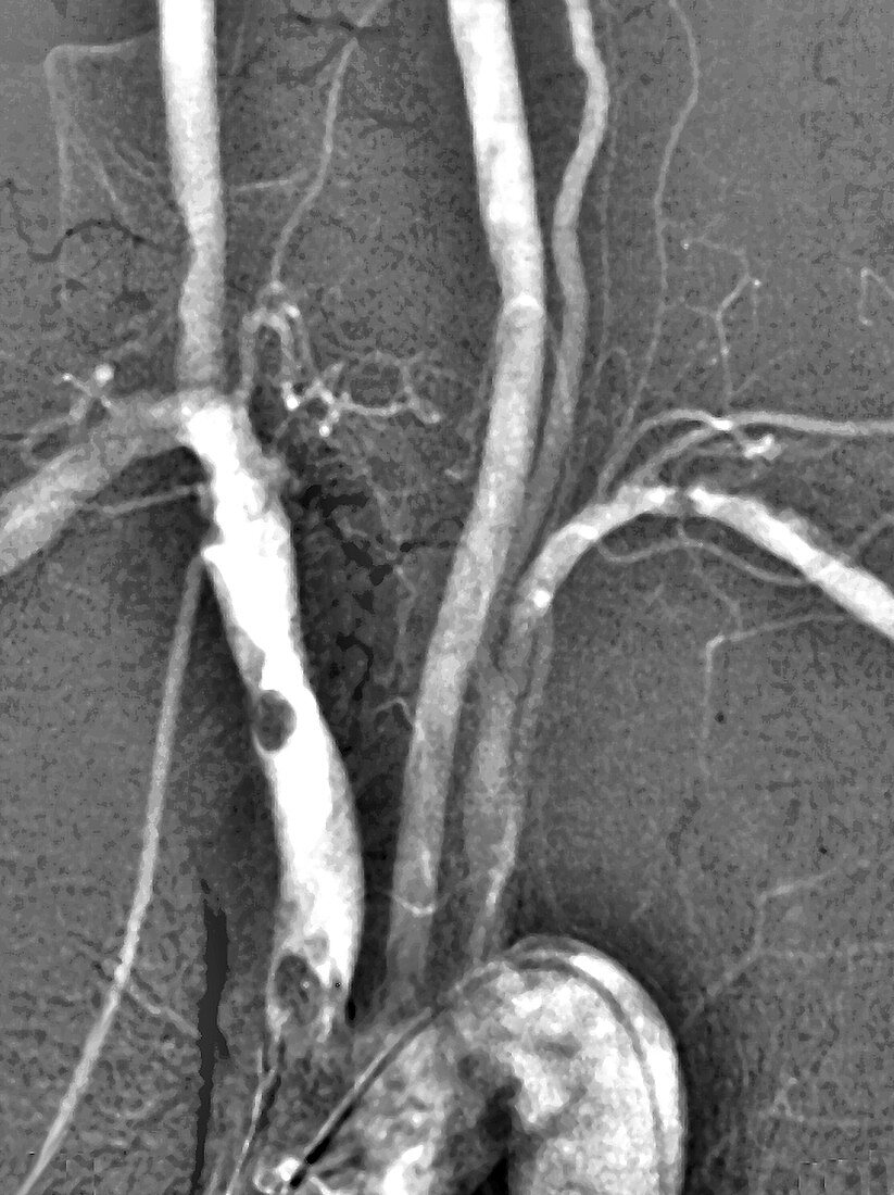 Atheroma in brachiocephalic artery, angiogram