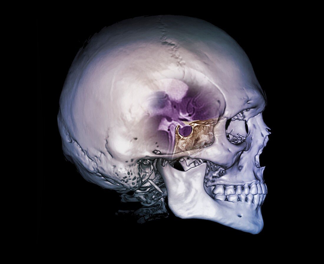 Human skull and site of pituitary gland, CT and MRI scans