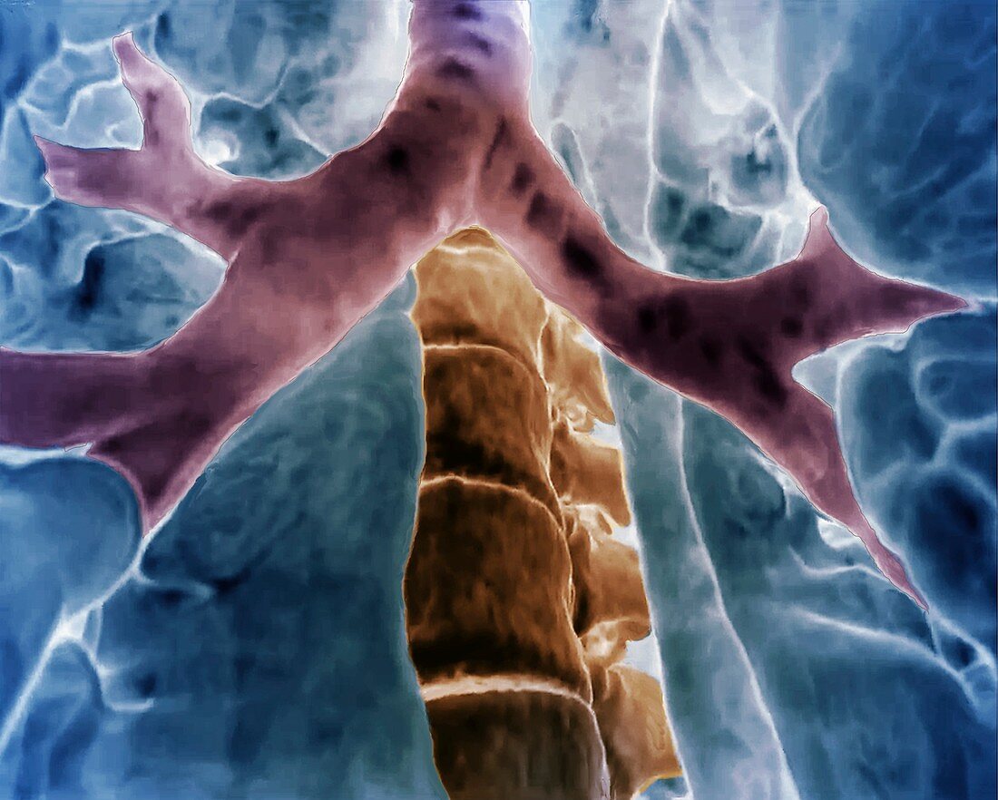 Bronchial divisions, 3D CT scan