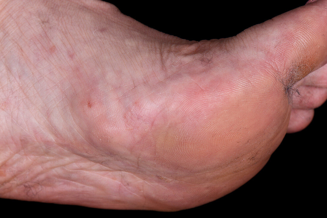 Fibromatosis of the foot