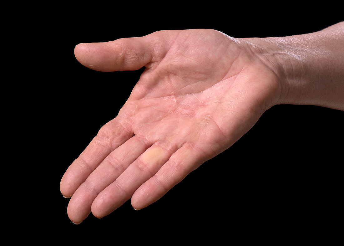 Reoccurring Dupuytren's contracture