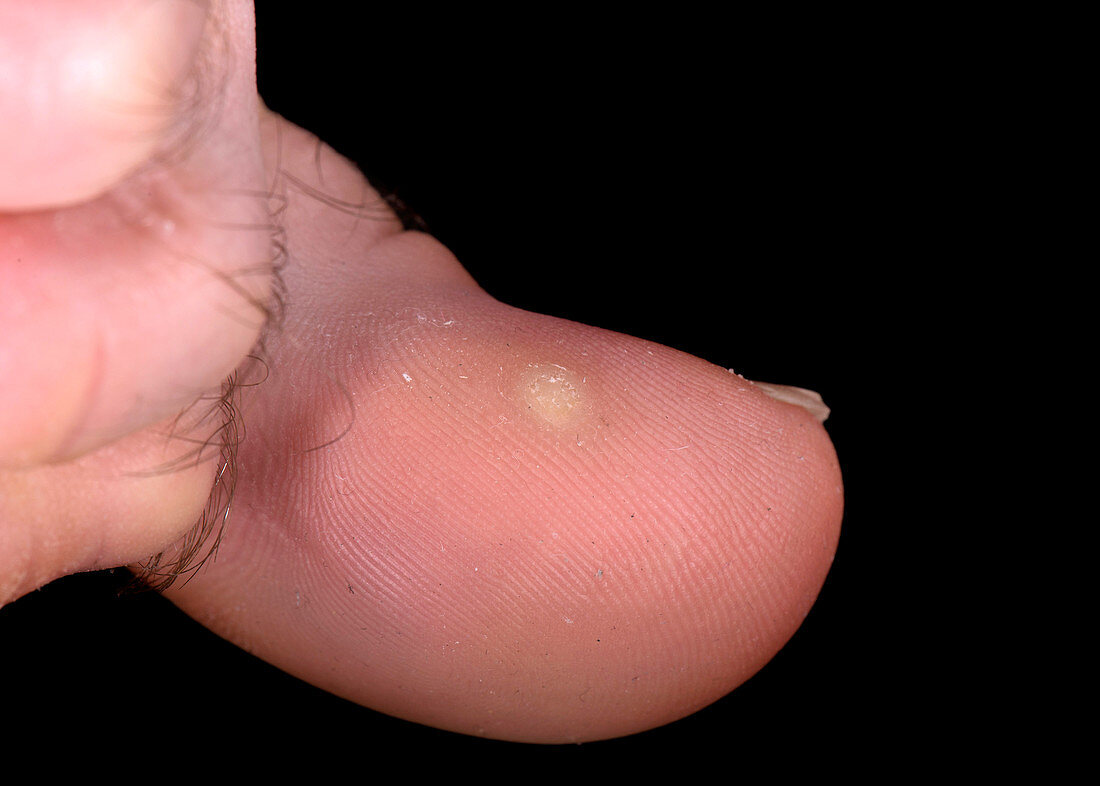 Common warts