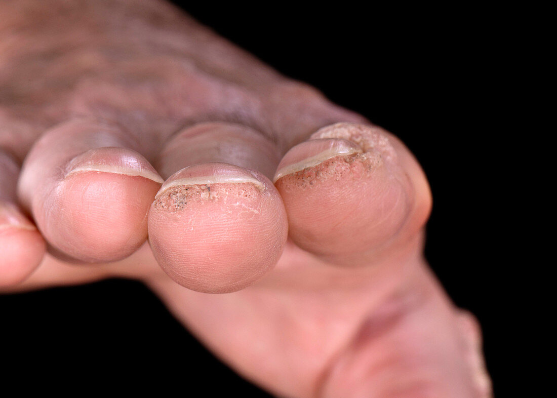 Common warts