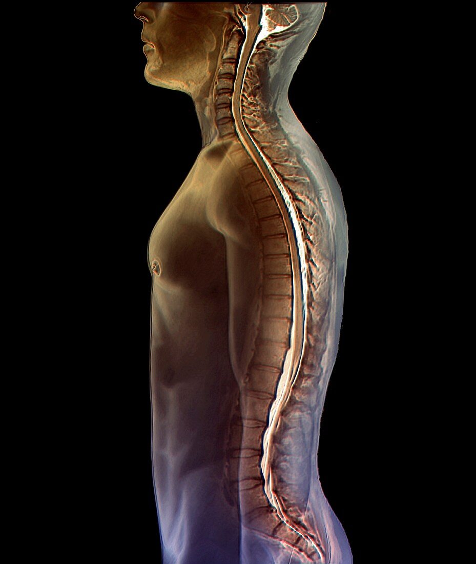 Backbone and spinal cord, MRI scan
