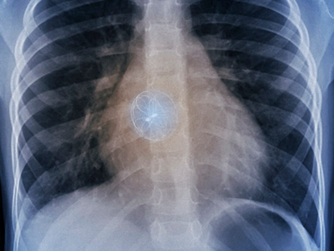 Heart defect implant, X-ray