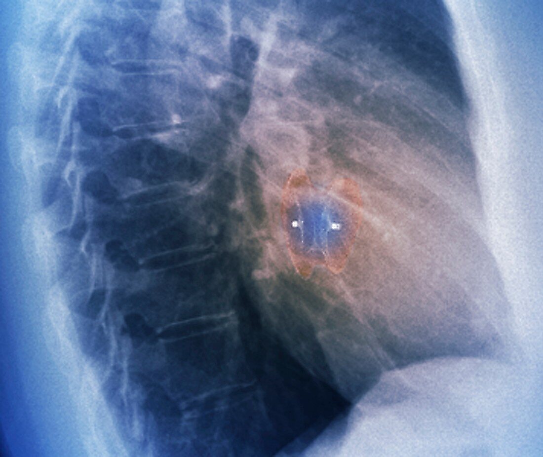 Heart defect implant, X-ray