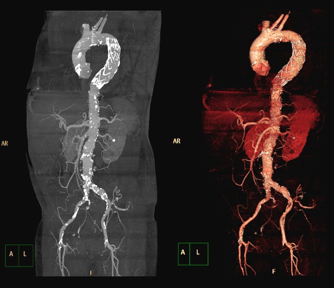 Stent in aortic aneurysm, 3D CT angiograms