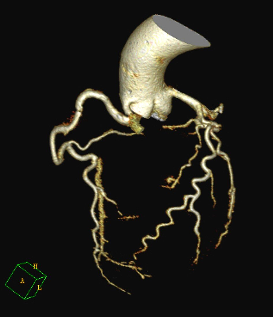 Coronary artery evaluation, 3D CT angiography