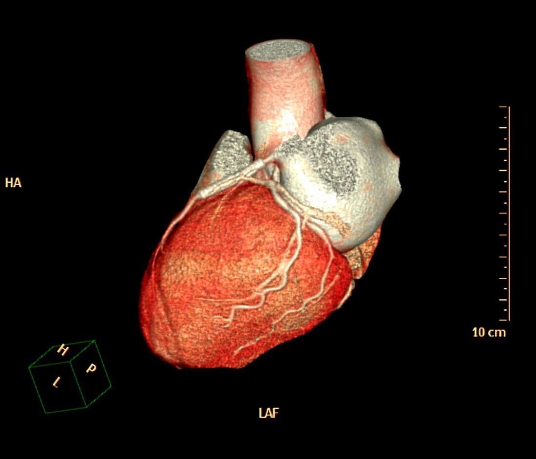 Coronary artery stent evaluation, 3D CT angiography