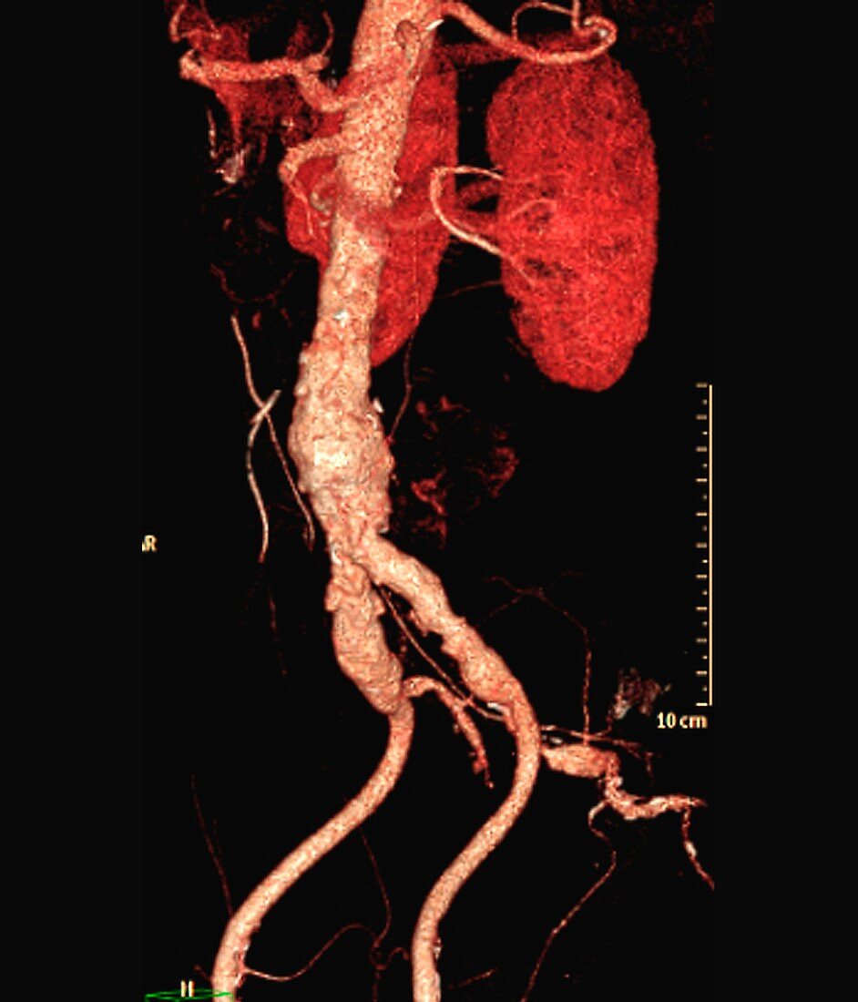 Cholesterol embolism, 3D CT angiogram