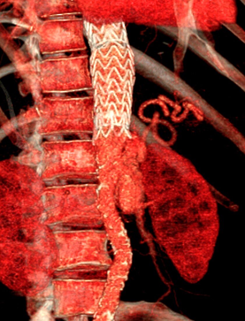Stent in aortic dissection, 3D CT angiogram