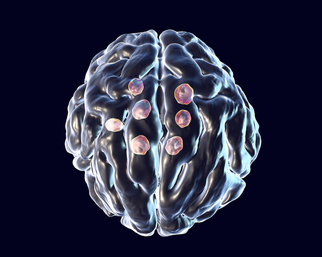 Cryptococcal brain lesions, illustration