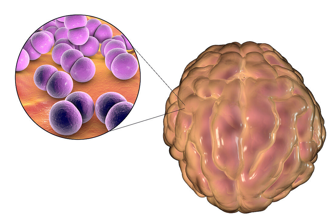 Meningitis caused by bacteria, illustration