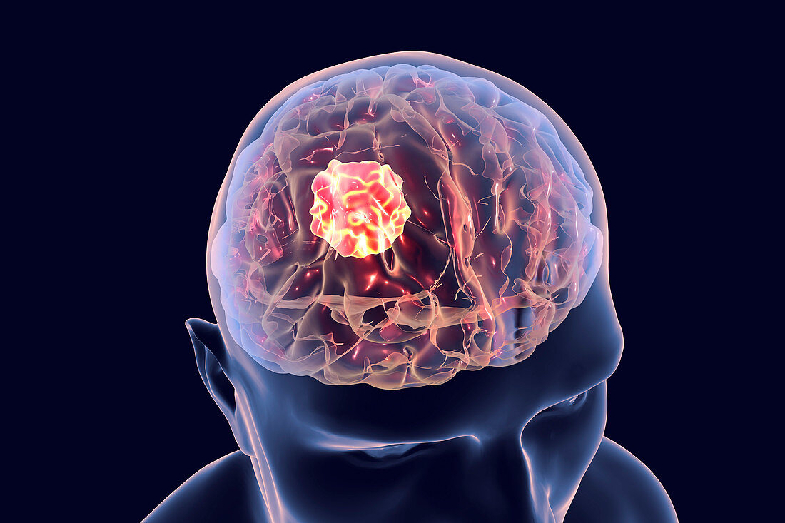 Brain cancer, illustration