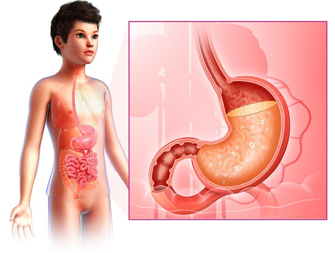 Child with stomach acidity, illustration