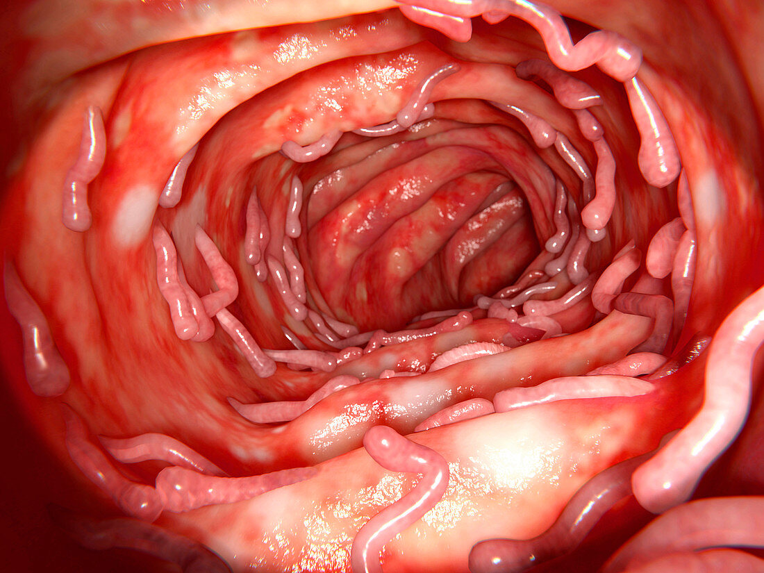 Ulcerative colitis and pseudopolyps, illustration