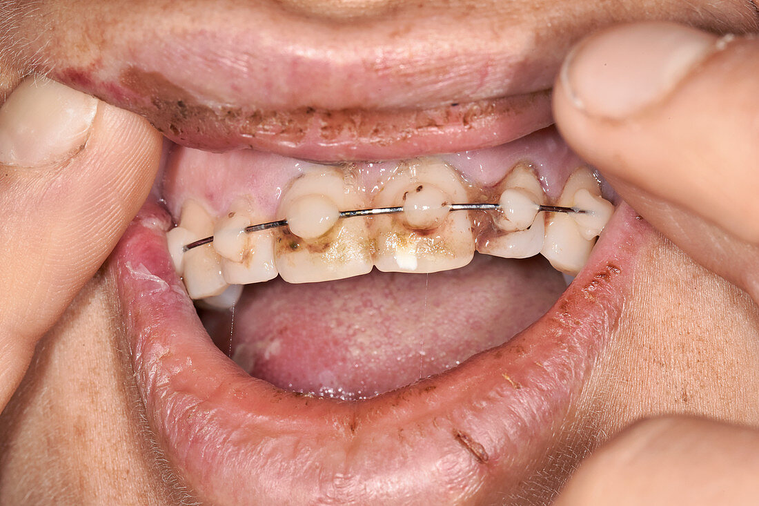 Dental repair using tooth brace