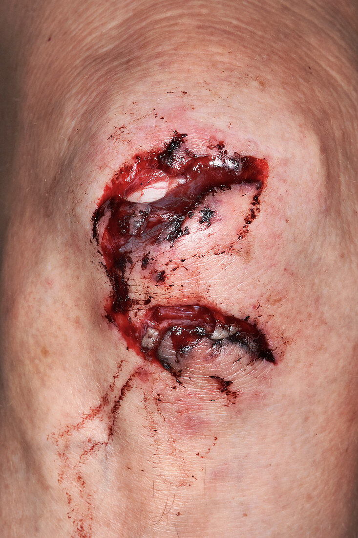 Deep knee lacerations
