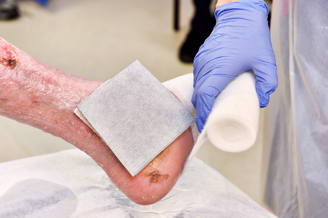 Treatment of ankle blister and ulcers