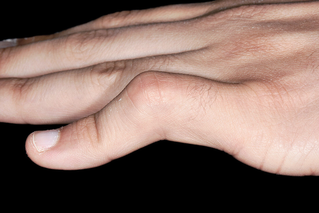 Deformity following dislocated finger