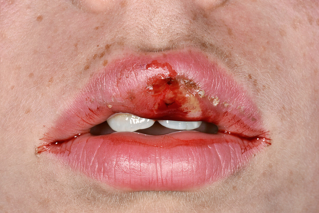 Infected split lip