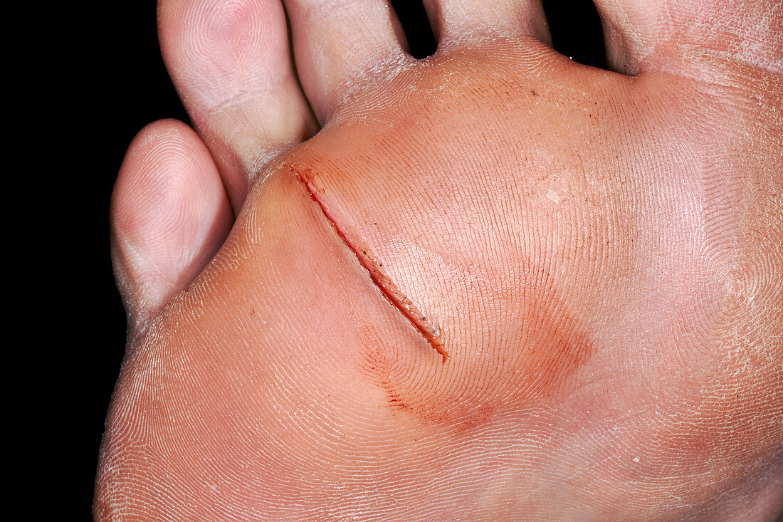 Laceration to sole of foot
