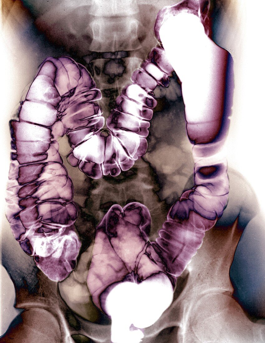 Normal colon,X-ray