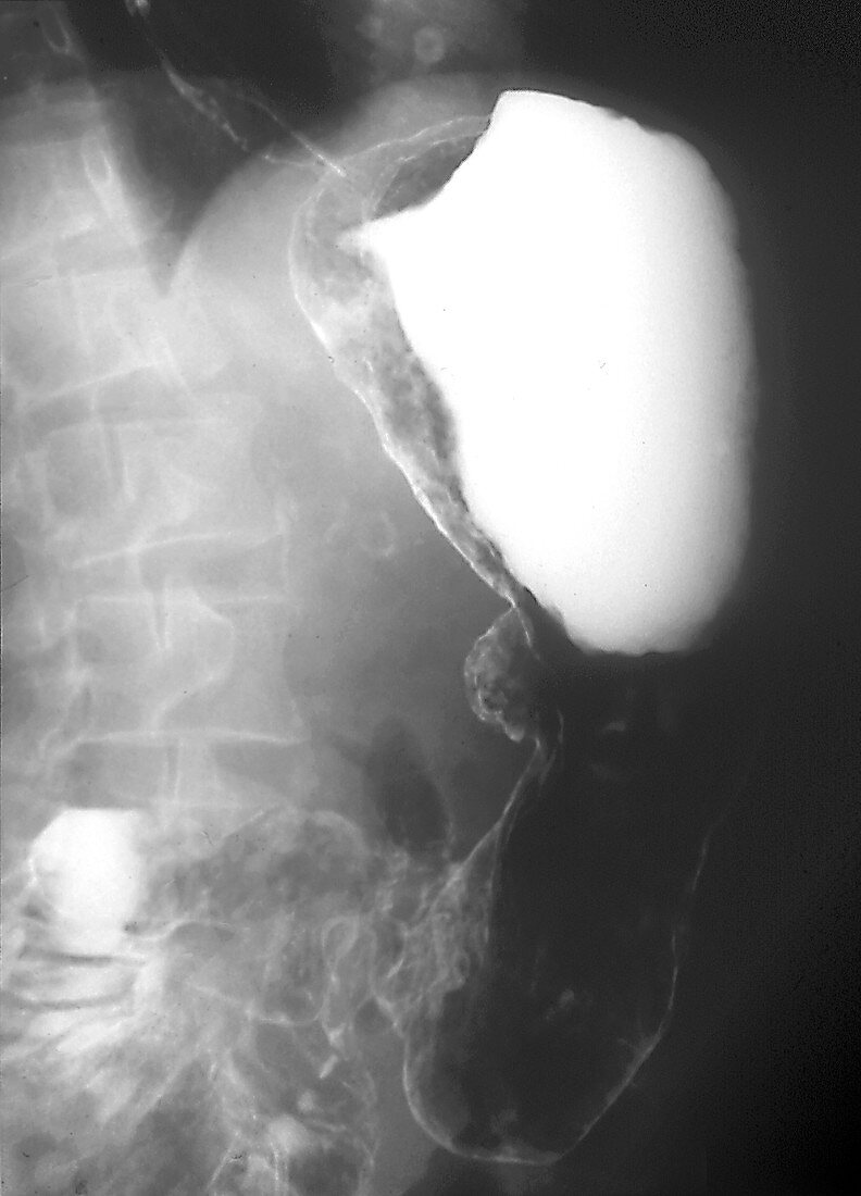 Gastric lymphoma stomach cancer,X-ray