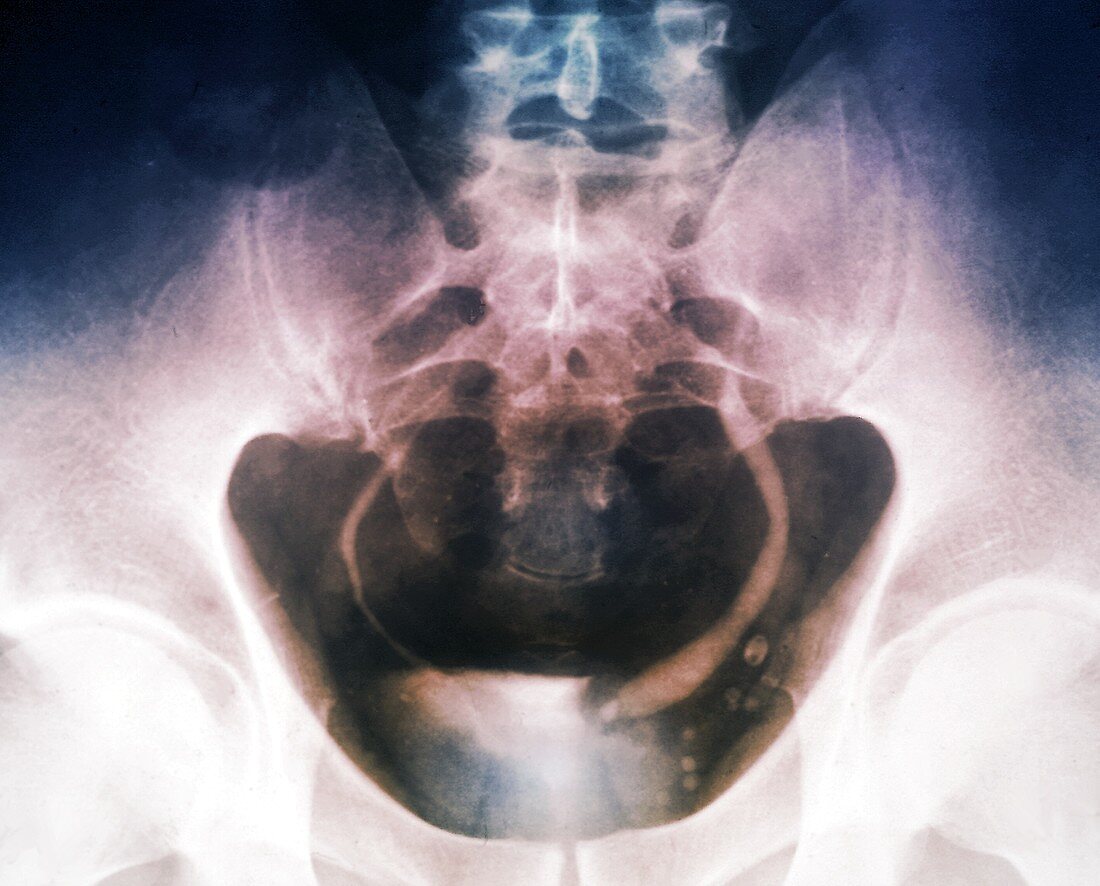 Ureterocoele,X-ray
