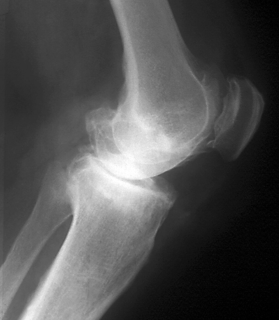 Osteoarthritis of the knee,X-ray