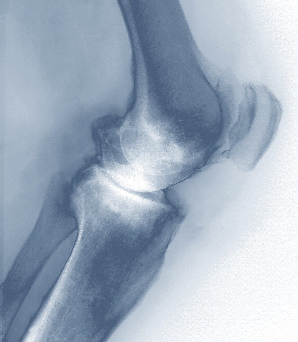 Osteoarthritis of the knee,X-ray