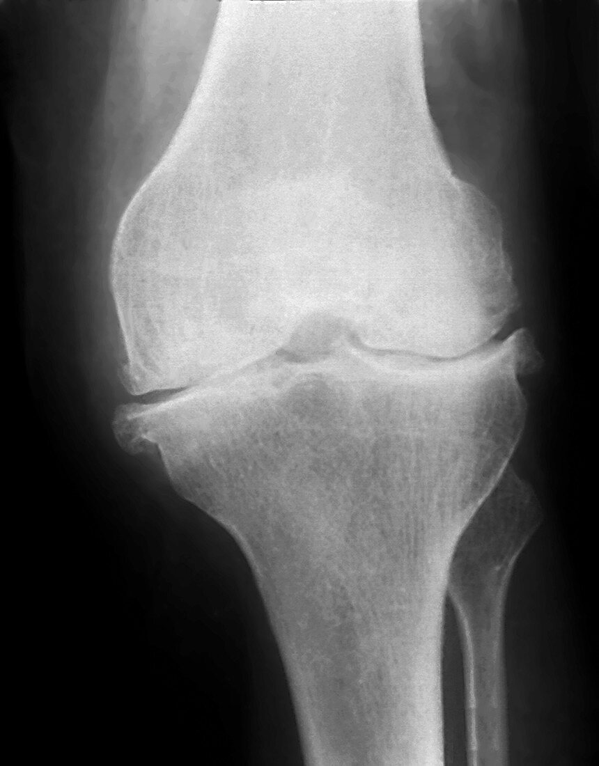 Osteoarthritis of the knee,X-ray