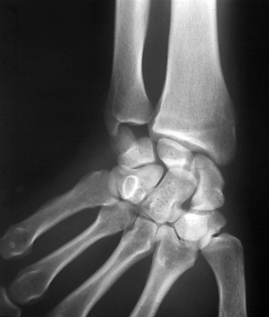 Broken wrist,X-ray