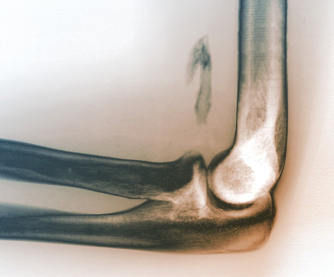 Osteoma,X-ray