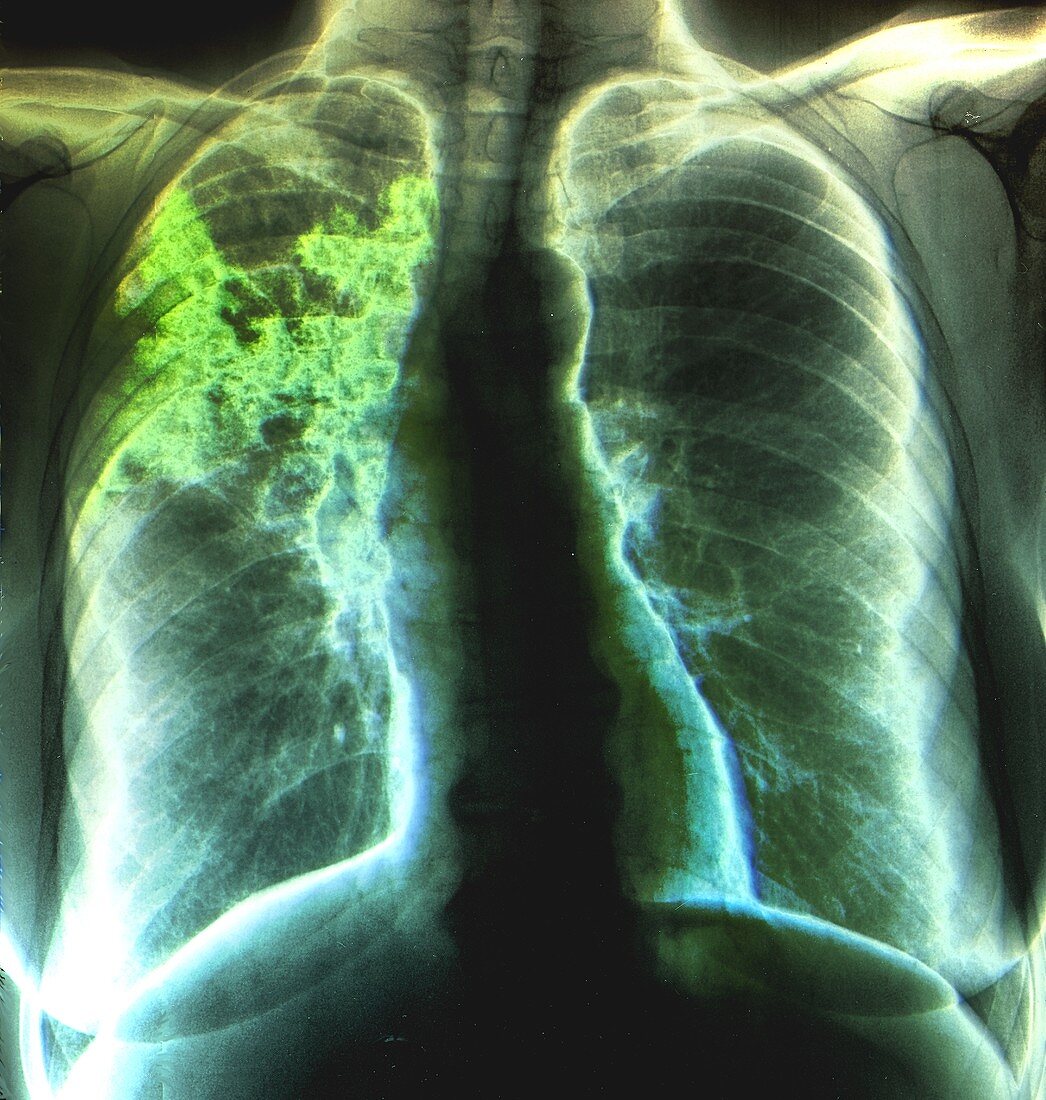 Pneumonia,X-ray