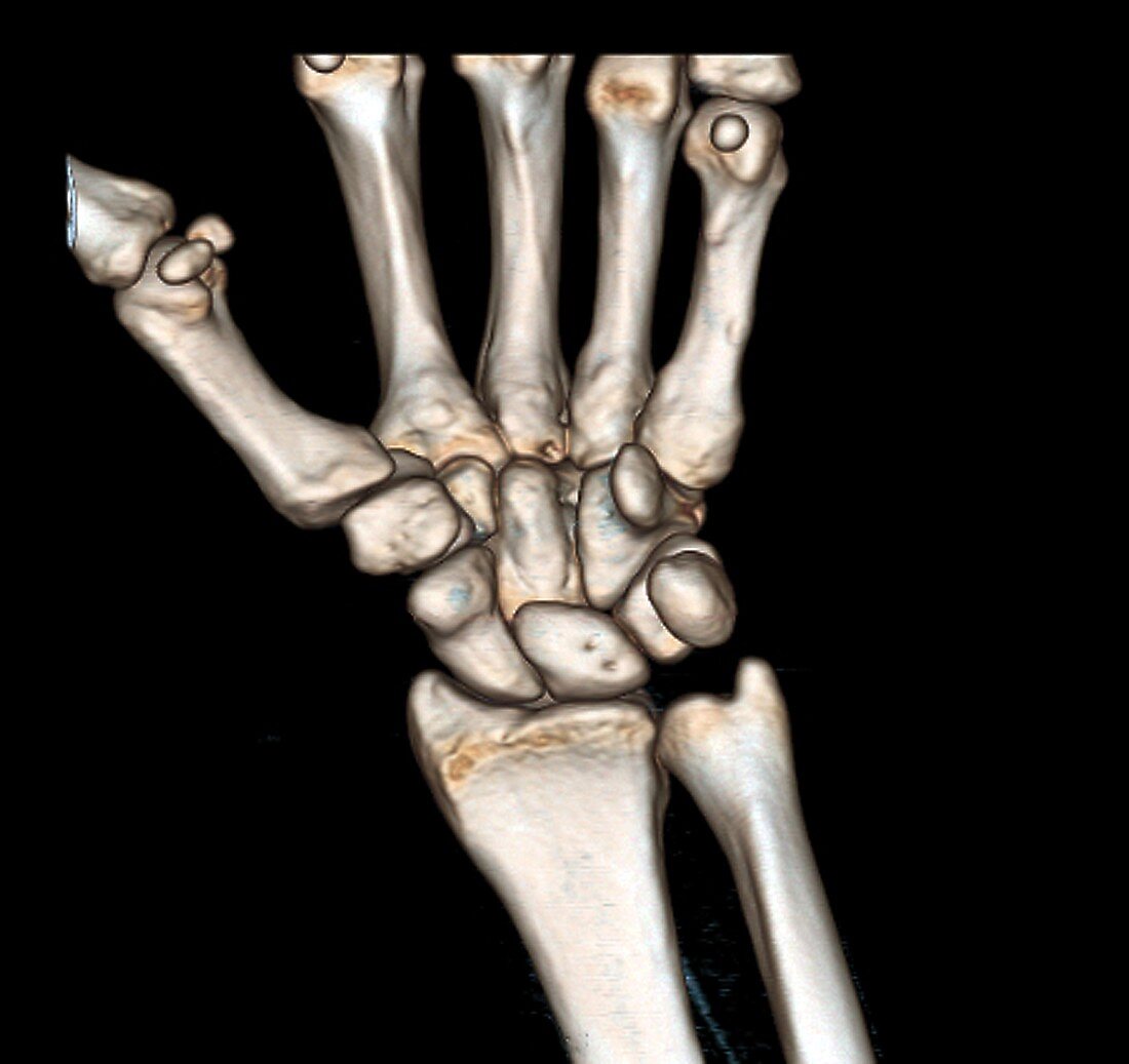 Normal wrist,3D CT scan