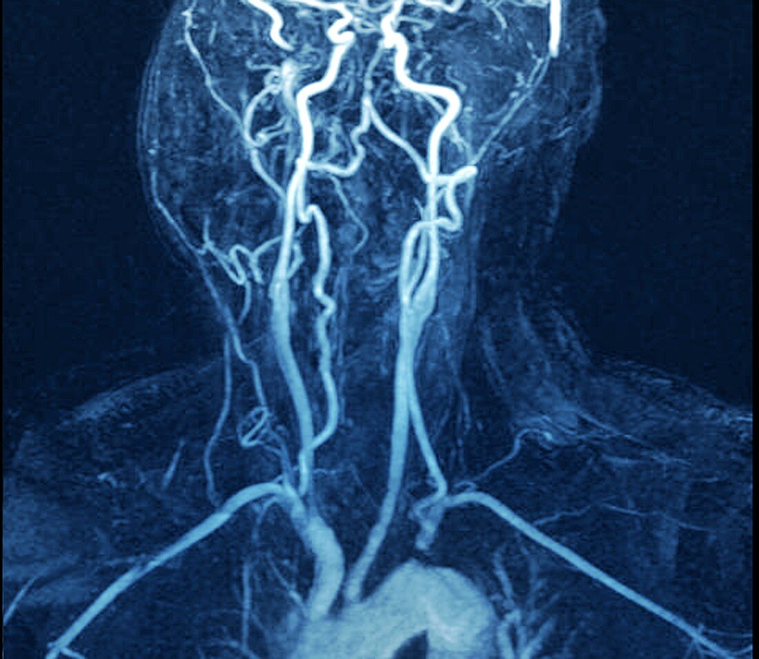 Left subclavian artery blockage,MRA scan