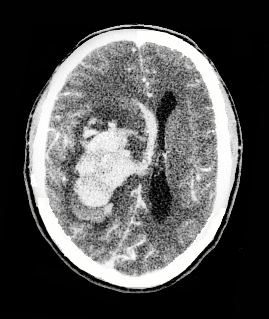 Intraparenchymal haemorrhage,CT scan