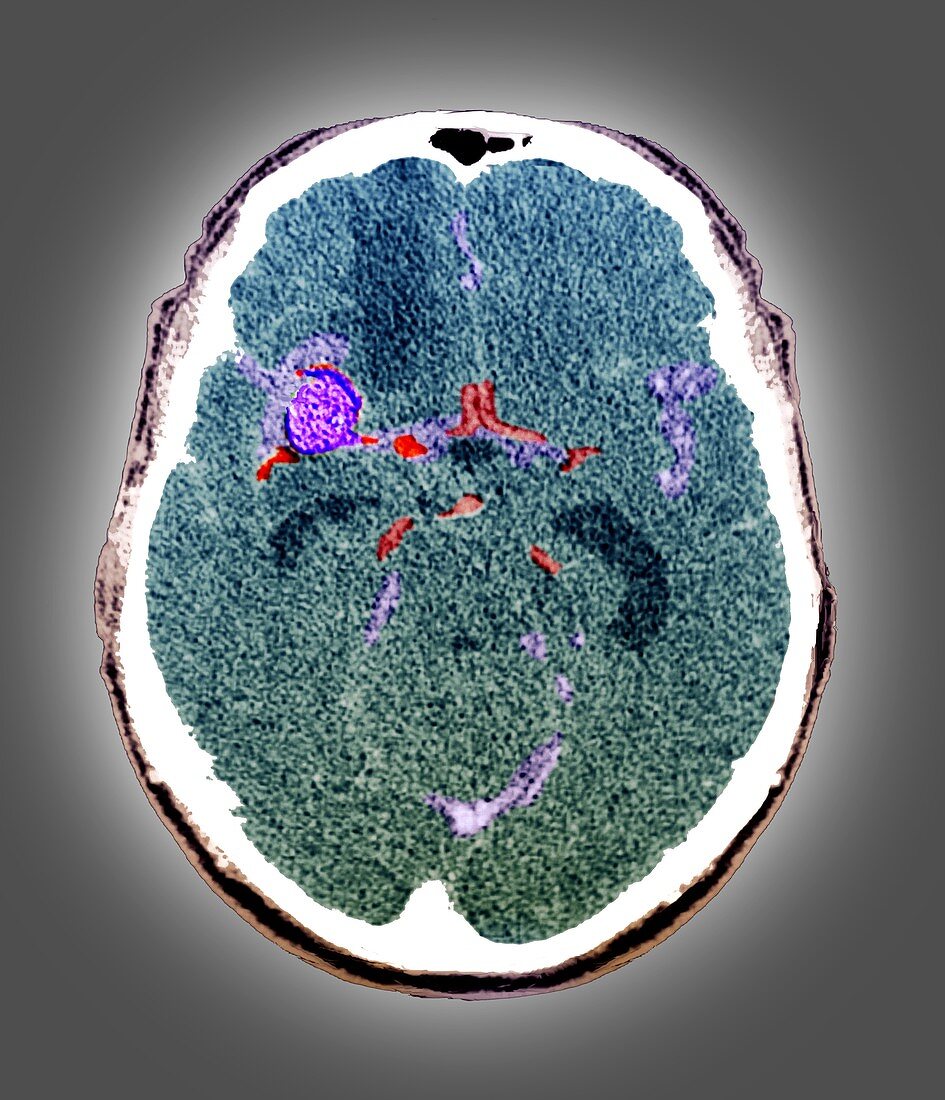 Subarachnoid haemorrhage,CT scan