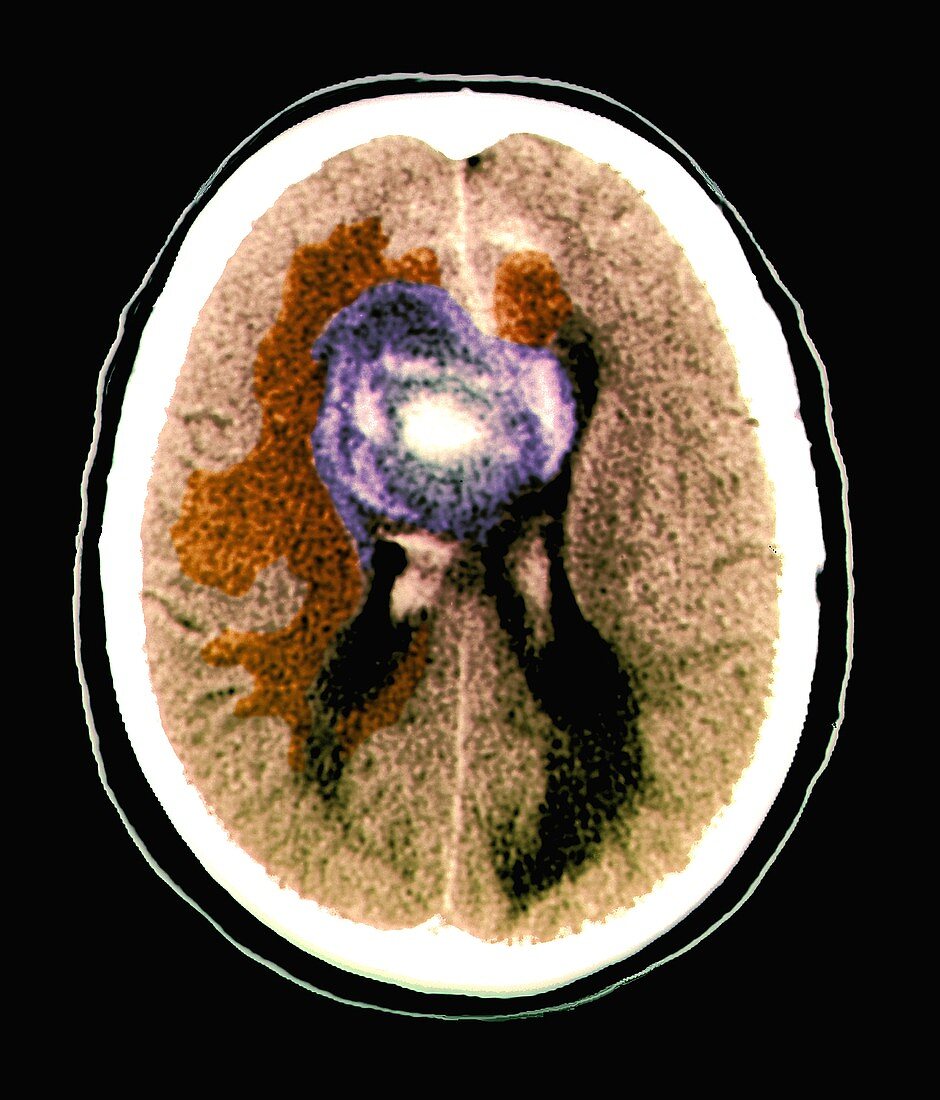 Glioblastoma cancerous brain tumour,CT scan