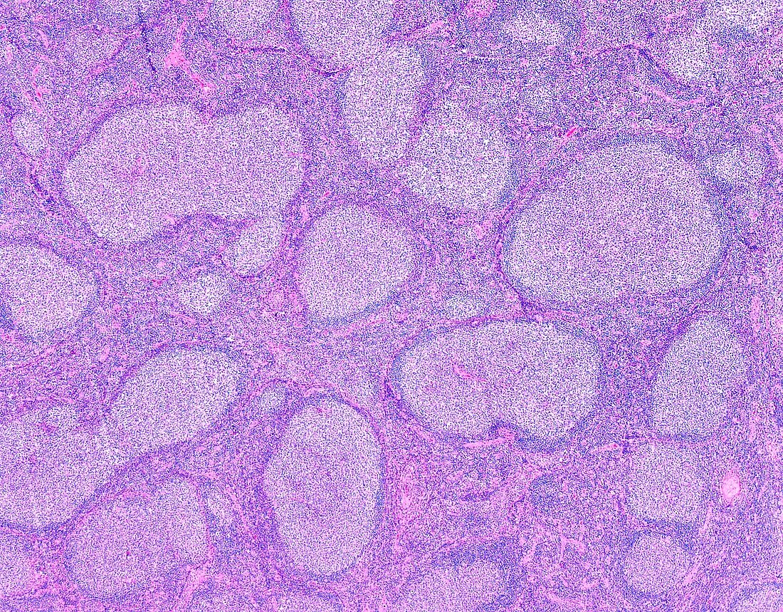 Follicular lymphoma,light micrograph