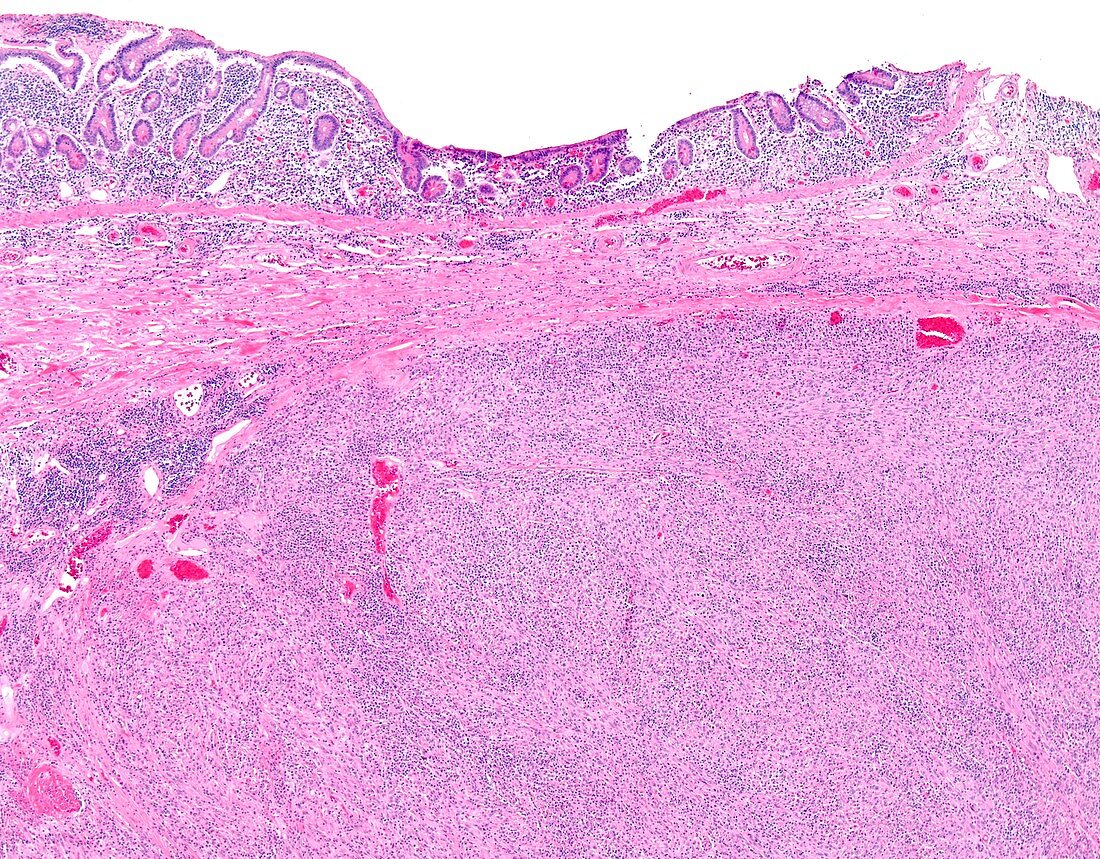 Follicular dendritic cell sarcoma,light micrograph