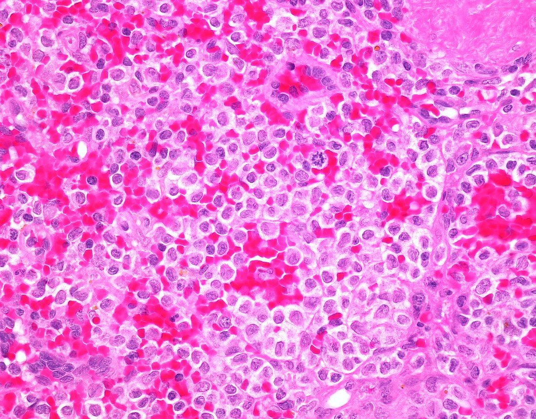 Hairy cell leukaemia,light micrograph
