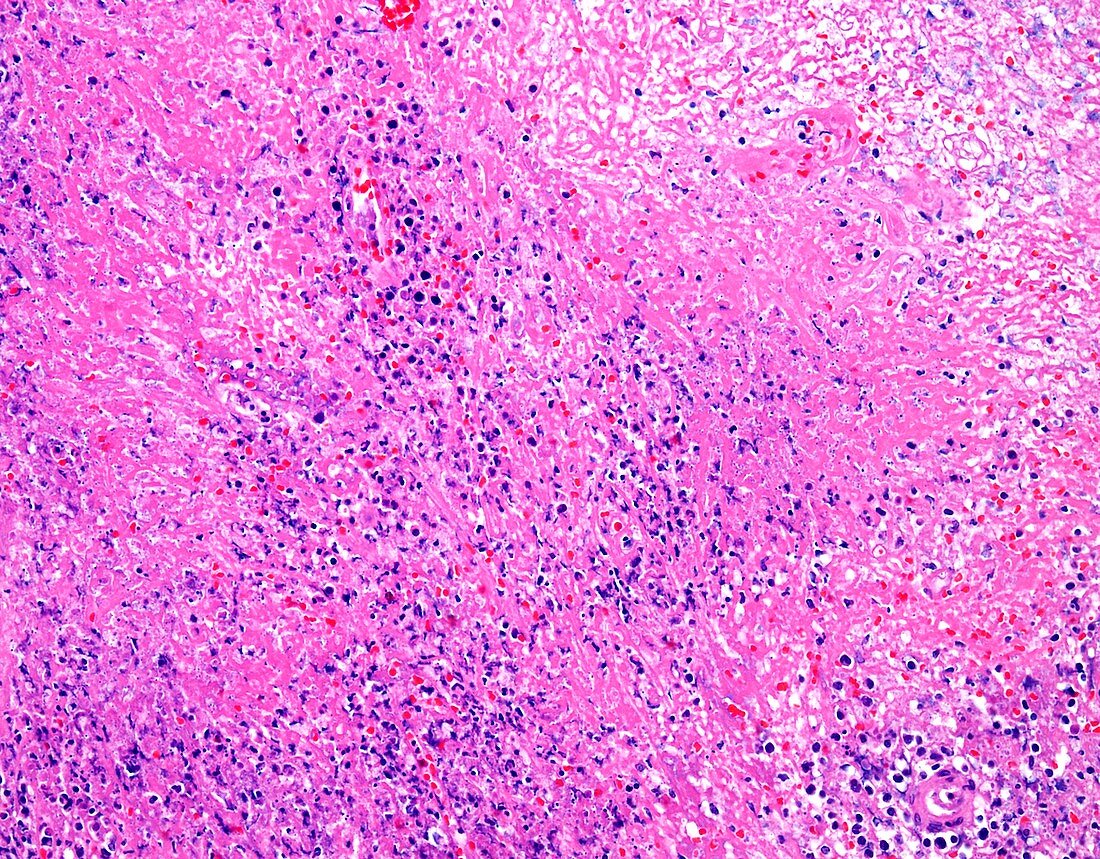 NK T-cell lymphoma,light micrograph