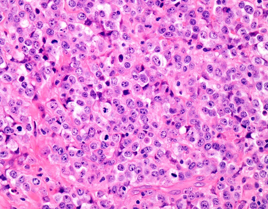 Plasmablastic lymphoma,light micrograph