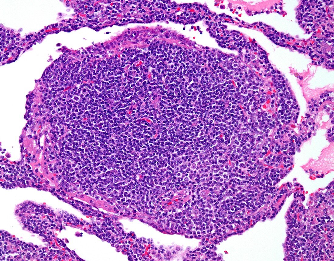 Small lymphocytic lymphoma,light micrograph