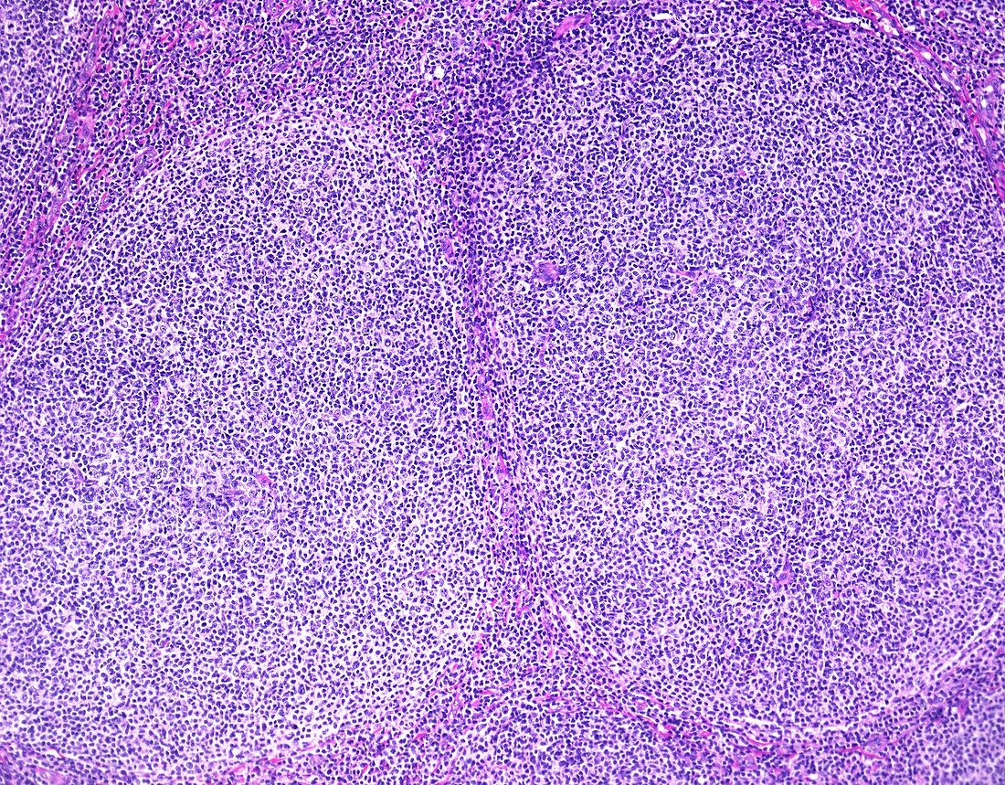 Follicular lymphoma,light micrograph